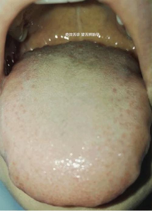 澳门今晚开奖结果+开奖记录和舌根和牙龈被缝一起与舌根和牙龈被缝一起怎么办